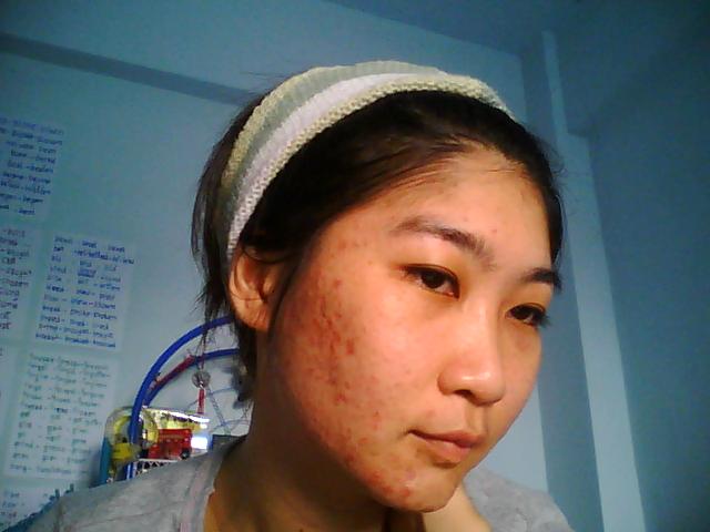 รักษาสิว