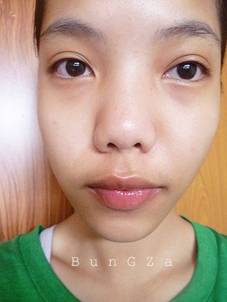 วิธีรักษาสิว