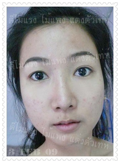 รักษาสิว