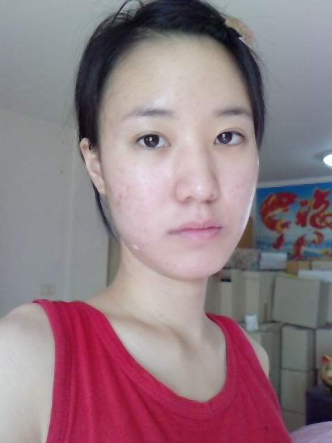 รักษาสิว