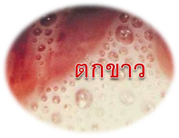 ตกขาว อาการตกขาว เป็นอย่างไร อ่านสาเหตุและวิธีรักษาอาการตกขาว