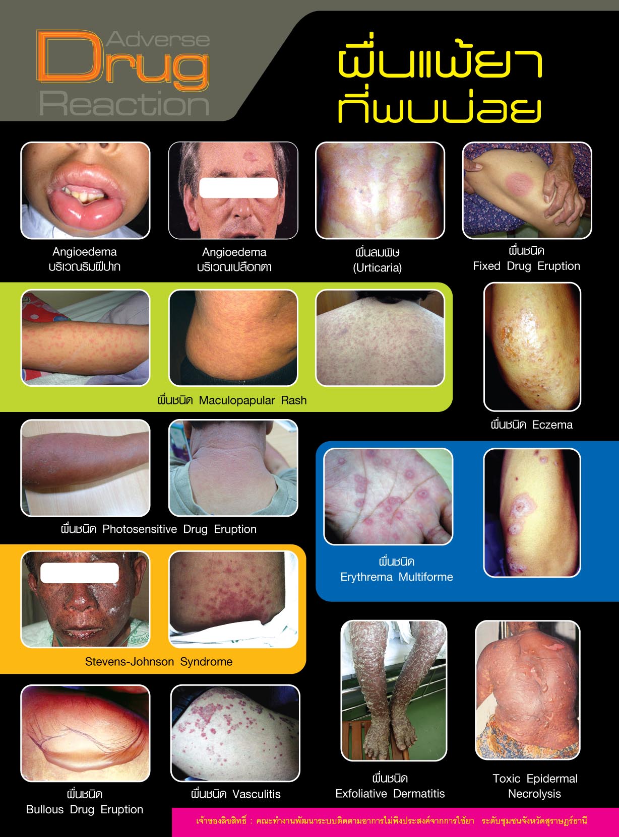 แพ้ยา ผลข้างเคียงของยา