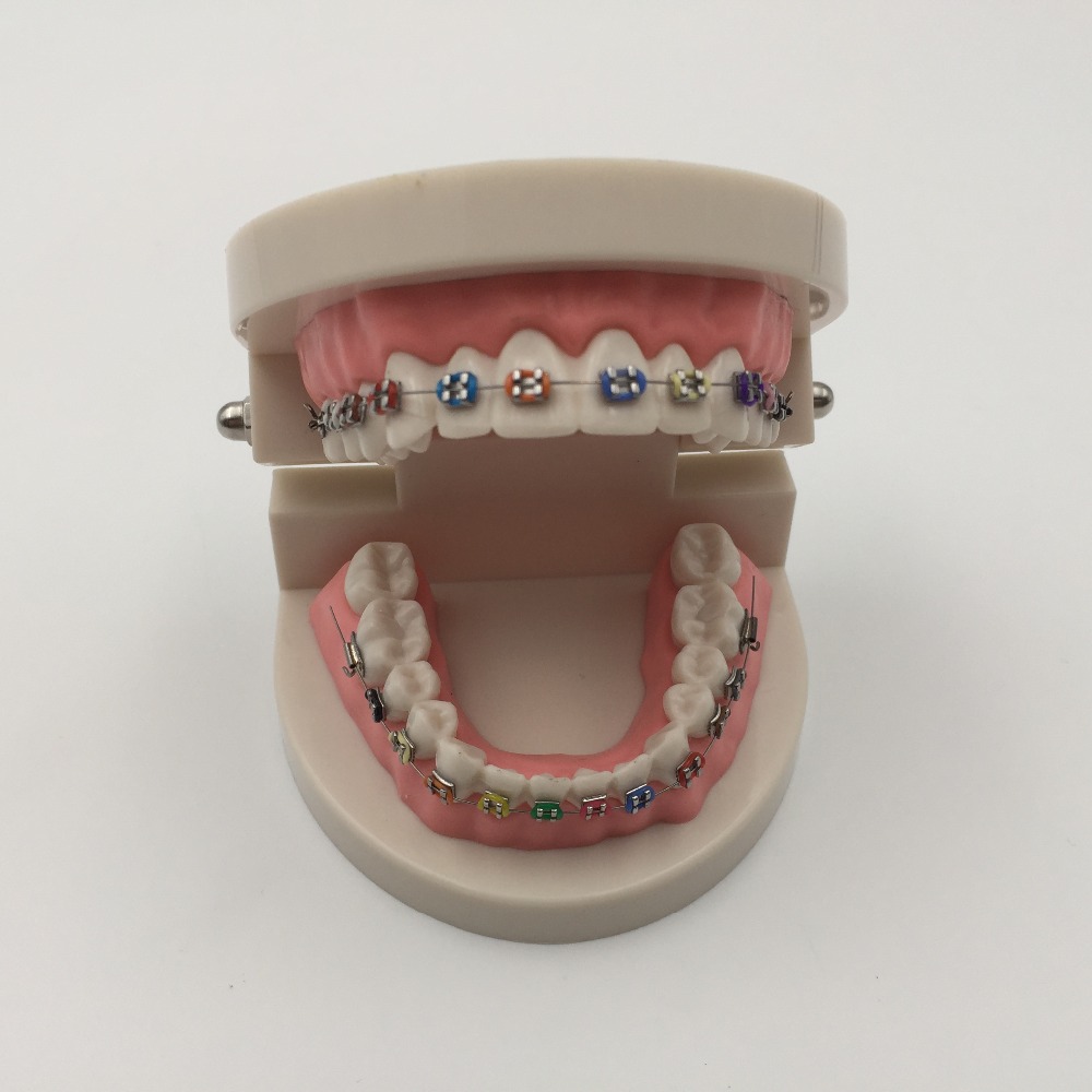 HiTube Braces moving teeth too fast? จัดฟัน