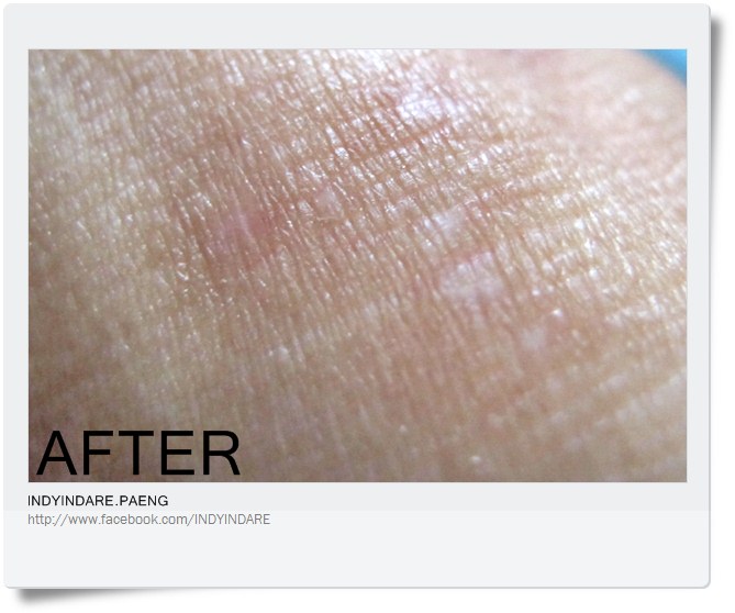 อัลบั้ม 95+ ภาพ แผล ตกสะเก็ด ใหม่ที่สุด