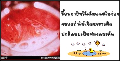 คันช่องคลอด ไม่มีตกขาว