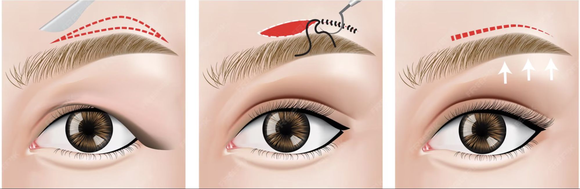 subbrow lift