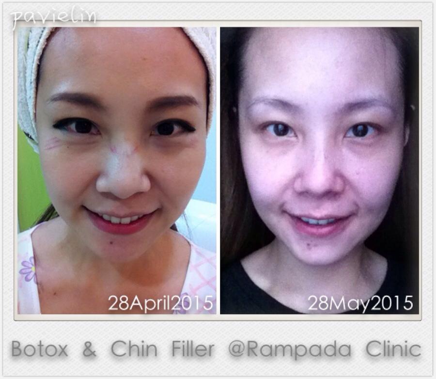 Golden Ratio Review Before After Rampada international Skin Clinic  ͹ ѧ ⺷͡ Ŵͺ˹ ¡  մ ҧ Կ˹ҴҤԹԡ