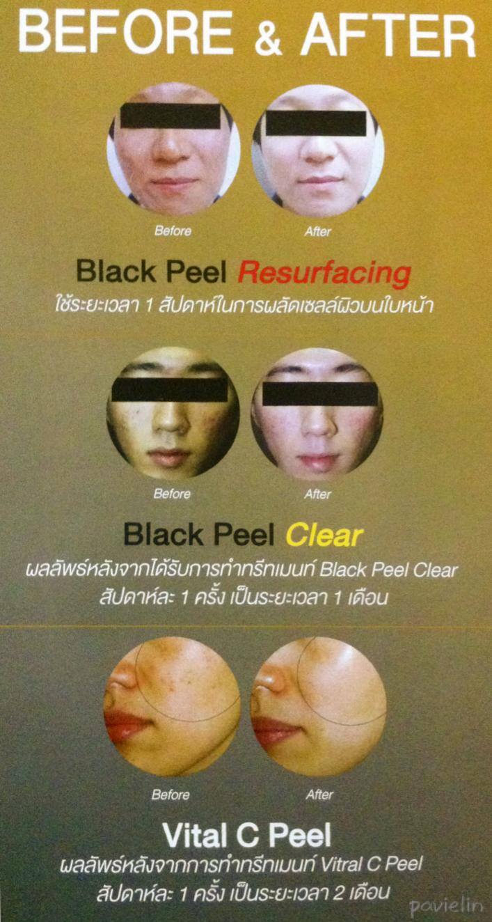 Result Before After Black Peel Resurfacing Clear Vital C Vitamin