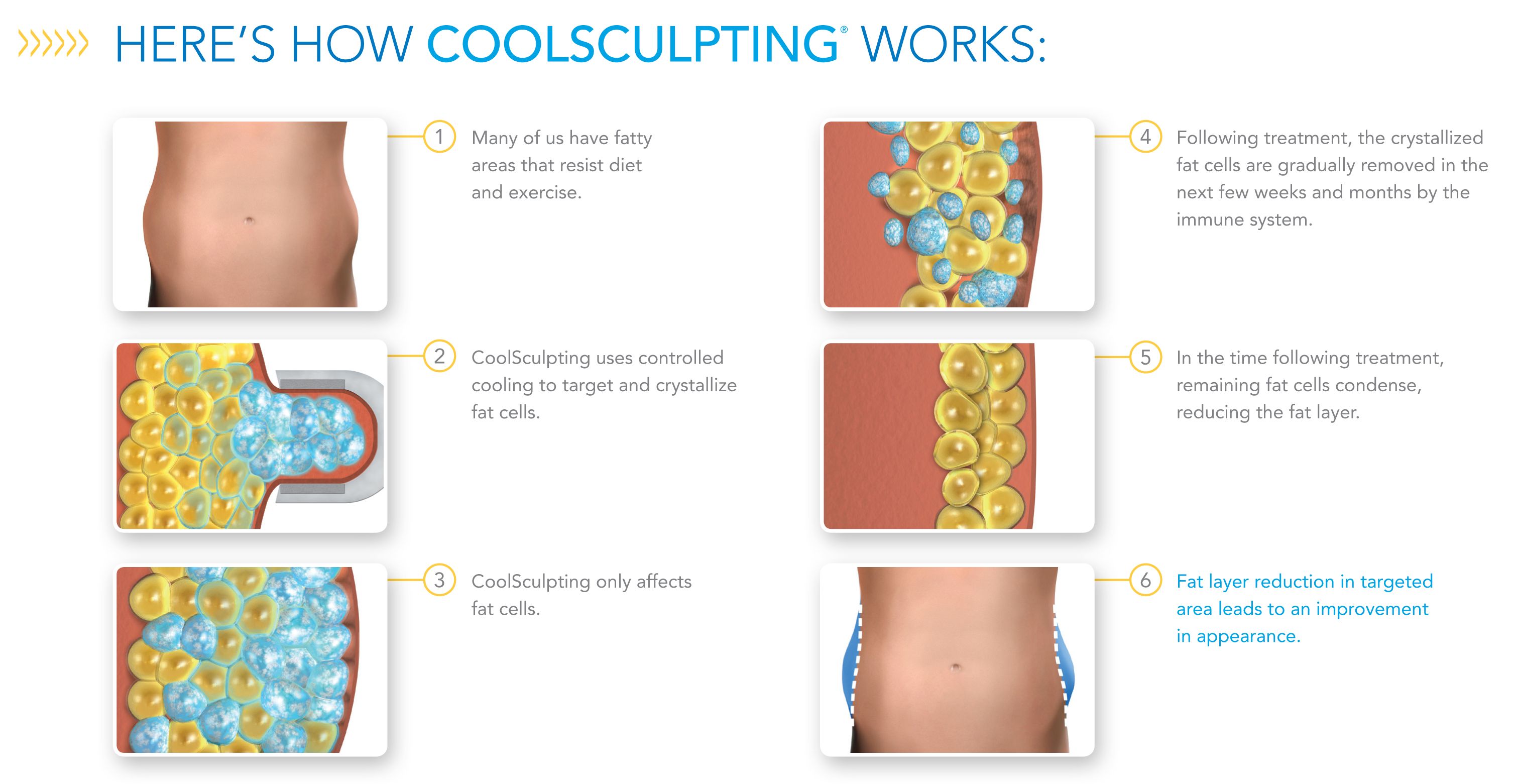 Coolsculpting How it works 