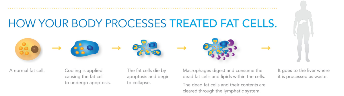 How Your Body Processes Treated Fat Cells Cryolipolysis Coolsculpting Apoptosis 