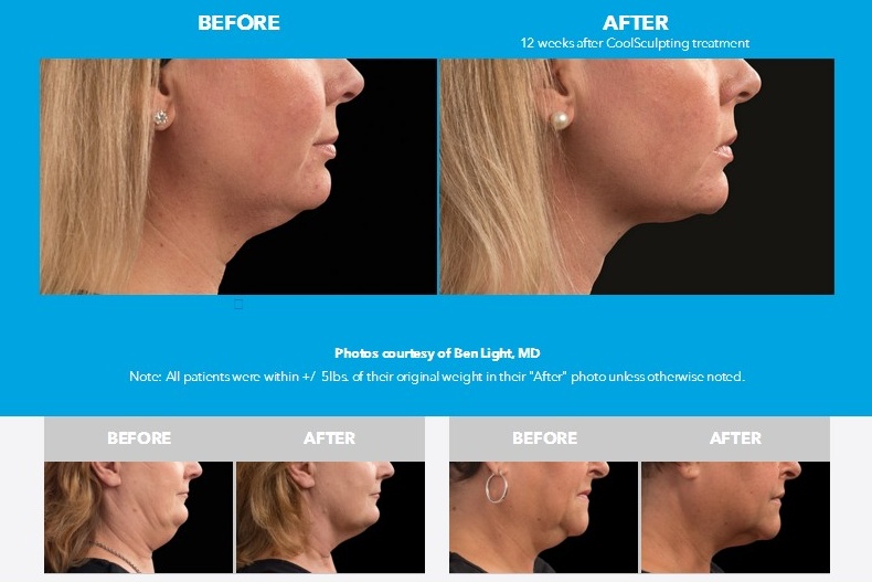 Double Chin Coolsculpting Rusult