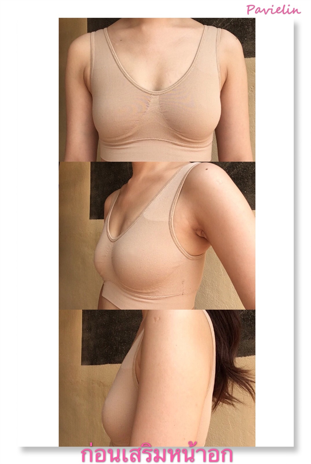 sport bra,support bra,,ЪѺ,Ѻ,ѧҵѴ,ӹ,Review , ,Masterpiece,Hospital,ի˹͡,,֡,Ҥ,breastaug ,breast,augmentation ,implant,mentor ,usa,masterpiececlinic,boobs ,sexy ,˹͡,,͡,˹͡Ҥ,˹͡˹,ӹ˹,¡,˹͡˭ , ,ҹ , ,ҵѴҹ ,˹͡ ,Siltex,High Profile,Before,After,͹,ѧ,