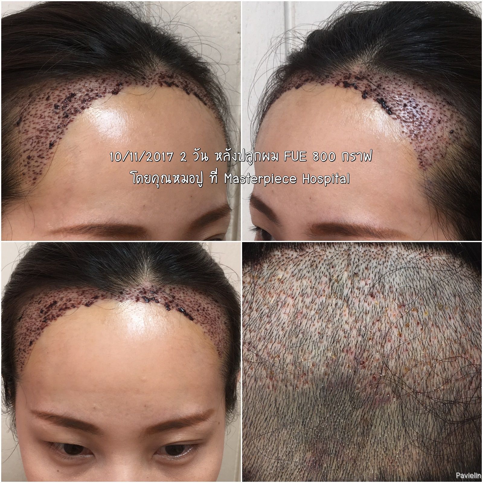 Masterpiece,Hospital,Clinic,Lab,Plastic Surgery,¡,Ǩҧ,Ǩʹ,͹¡,,˹͡,,˹Ҽҡ,ի,ԹԤ,çҺ,١,ͻ,michelle_wd,ʹ,,Ҥ,ºº,١,ʹ,鹪,,,͹,ѧ,,PRP,A Cell,scar,after,surgery,fut,fue,hair robot,