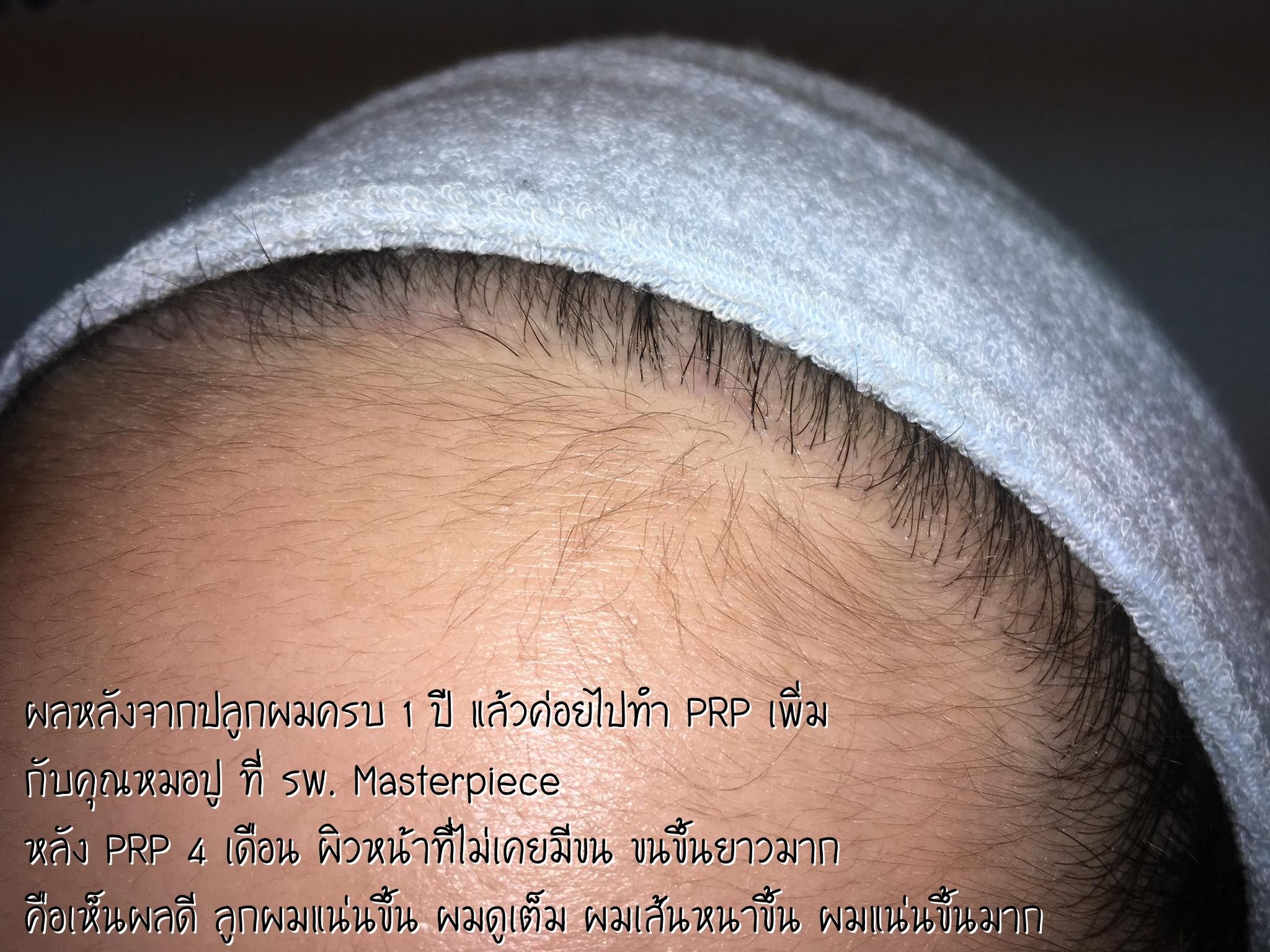 Masterpiece,Hospital,Clinic,Lab,Plastic Surgery,¡,Ǩҧ,Ǩʹ,͹¡,,˹͡,,˹Ҽҡ,ի,ԹԤ,çҺ,١,ͻ,michelle_wd,ʹ,,Ҥ,ºº,١,ʹ,鹪,,,͹,ѧ,,PRP,A Cell,scar,after,surgery,fut,fue,hair robot,