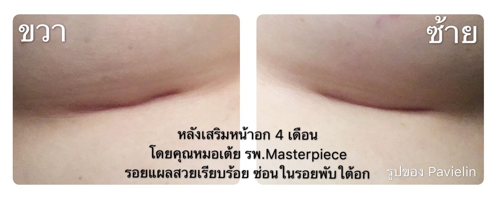 Review , ,Masterpiece,Hospital,ի˹͡,,,֡,Ҥ,breastaug ,breast,augmentation ,implant,mentor ,usa,masterpiececlinic,boobs ,sexy ,˹͡,,͡,˹͡Ҥ,˹͡˹,ӹ˹,¡,˹͡˭ , ,ҹ , ,ҵѴҹ ,˹͡ ,Siltex,High Profile,Before,After,͹,ѧ,