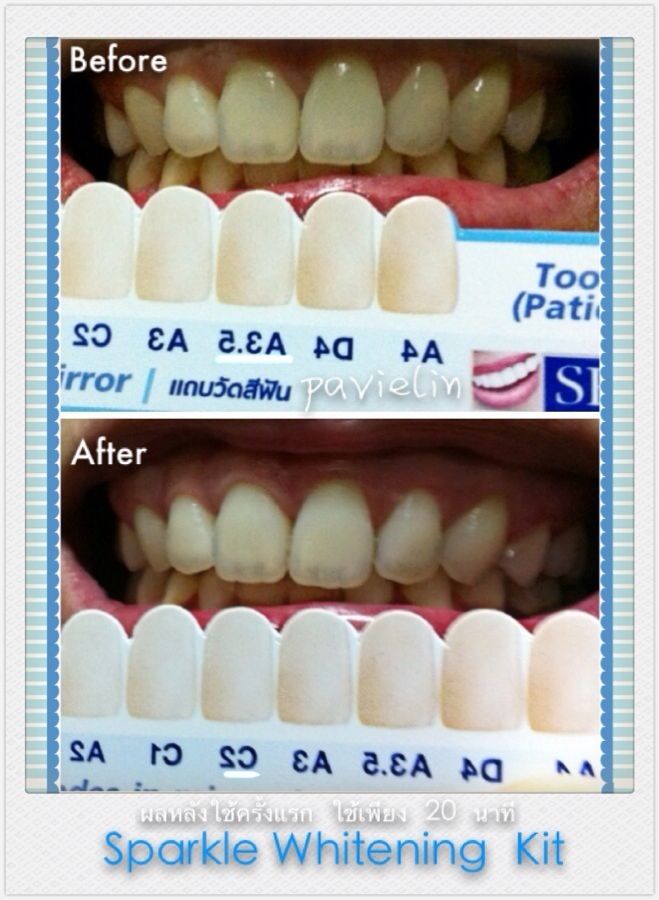 Crest 3D White Luxe Professional Effects Whitestrips Vita toothguide 3d master classic system ᶺѴдѺ-ͧͧѹ Ѻ͡տѹ ͡տѹǴµͧ Ǣ 20 ҷ Sparkle ʻտѹشǷ෹觤Է30 cool light whithening laser ͡տѹ ŷ  ǿѹ شſ͡ѹ ʻ Ƿ෹ Է ѹǢ Ѵ˧͡ ǿѹ ǪѹǢ 20 ҷ #ʻ #MySparkle #Sparkle #WhiteningKit #Cosmetic #Review #Result #frobbsthailand #TeethWhiteningKit #TeethWhitening #TeethBleaching #HomeBleaching #Kuron #Lesasha