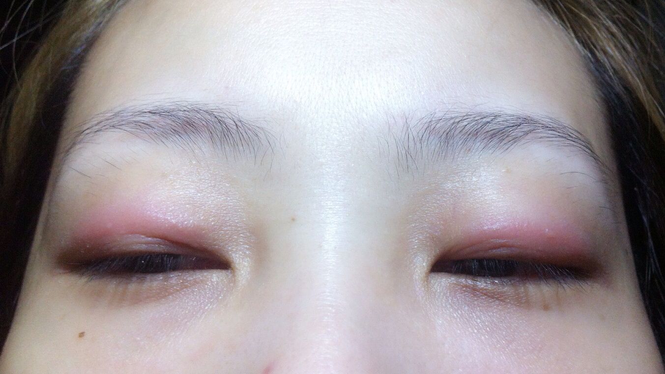 double eyelid sticker allergy  Դ  ͡ glue ҡüԴѧ ֡ѹǳ ѡʺ  ᴧ, ʺ͡Ҿҡ෻ѹԴ Ҵ֧͡ѹ ҡ ʹ֧çҨպҧ   ѧͧ͡ ҹ仪ǡ֡ѹ  µͧԡԴ» »Ѩ·ҧҹآҾ ·ѧ͡ҡ礧е͵ҹ੾͹
