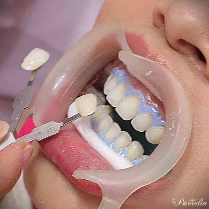 Cosmetic,Dentistry,thailand,bangkok,ا෾,ѹ,Dental,Smart,Clinic,dentalsmartclinic, ,ѹ,,Cool Light,͡տѹ,,Թԡ,ѹ, 繷,乷,,9,The Nine,Rama9, ,͡ѹ,͡,տѹ,,ѹͧ,,ѹ,Ҵ,   ʺó,,ǹ,繼,ѹᾷ,Ϳѹ,Ǩ, ,,ѹҧ,ŷ,Blue Light,ͧ,,ͧ,µͧ,ͧ,ҹ, ǿѹ,տѹ,ش,Ѵѹ,٧,,ʧ,Cool,light,whitening, ١,Ǣ,˵,ѹ,,In-office,tooth,Laser,,ŷ,Home,bleaching, ,,  ʹ,,,,Veneer,ä˧͡,ѹ,ѹ,ͺѹ,,͹,ѧ,,, ,ʧ,Oral Care,Colgate,Sensitive,Pro-Relief,ҡ,,ҹ,Ҥ,Ҵ,˹,VITA,Toothguide,3D,MASTER,