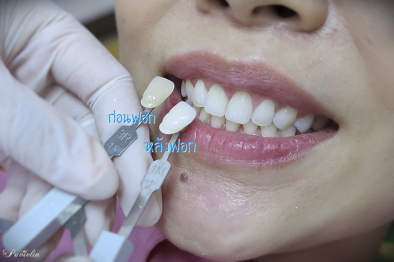 Cosmetic,Dentistry,Dental,Smart,Clinic,DentalSmartClinic, ,ѹ,,Cool Light,Cool,light,whitening,͡տѹ,,Թԡ,ѹ, 繷,乷,,9,The Nine,Rama9, ,͡ѹ,͡,տѹ,,ѹͧ,,ѹ,Ҵ,   ʺó,,ǹ,繼,ѹᾷ,Ϳѹ,Ǩ, ,,ѹҧ,ŷ,Blue,zoom,ͧ,,ͧ,µͧ,ͧ,ҹ, ǿѹ,տѹ,ش,Ѵѹ,٧,,ʧ, ١,Ǣ,˵,ѹ,,In-office,tooth,Laser,,ŷ,Home,bleaching, ,,  ʹ,,,,Veneer,ä˧͡,ѹ,ѹ,ͺѹ,,͹,ѧ,,, ,ʧ,Oral Care,Colgate,Sensitive,Pro-Relief,ҡ,,ҹ,Ҥ,Ҵ,˹, VITA,Toothguide,3D,MASTER,ӿѹ,Դͧҧ,ҧ,ѹ,Ըշ,ͺô,