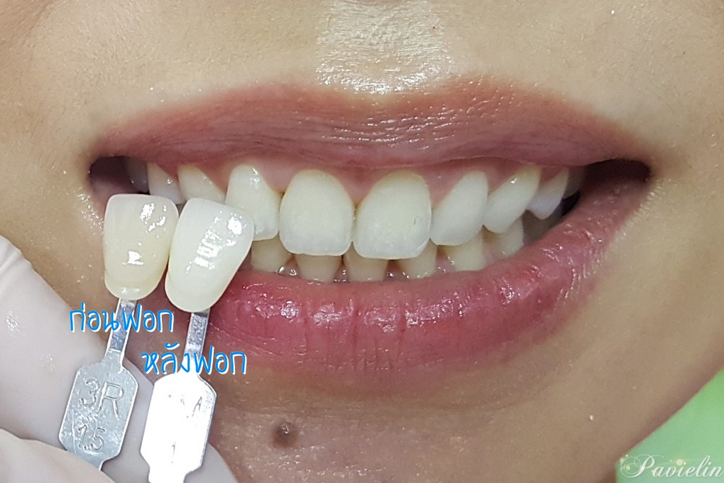Cosmetic,Dentistry,thailand,bangkok,ا෾,ѹ,Dental,Smart,Clinic,DentalSmartClinic, ,ѹ,,Cool Light,Cool,light,whitening,͡տѹ,,Թԡ,ѹ, 繷,乷,,9,The Nine,Rama9, ,͡ѹ,͡,տѹ,,ѹͧ,,ѹ,Ҵ,   ʺó,,ǹ,繼,ѹᾷ,Ϳѹ,Ǩ, ,,ѹҧ,ŷ,Blue,zoom,ͧ,,ͧ,µͧ,ͧ,ҹ, ǿѹ,տѹ,ش,Ѵѹ,٧,,ʧ, ١,Ǣ,˵,ѹ,,In-office,tooth,Laser,,ŷ,Home,bleaching, ,,  ʹ,,,,Veneer,ä˧͡,ѹ,ѹ,ͺѹ,,͹,ѧ,,, ,ʧ,Oral Care,Colgate,Sensitive,Pro-Relief,ҡ,,ҹ,Ҥ,Ҵ,˹, VITA,Toothguide,3D,MASTER,ӿѹ,Դͧҧ,ҧ,ѹ,Ըշ,ͺô,