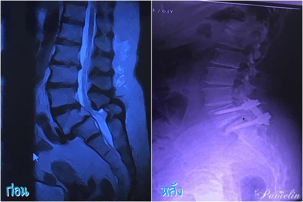 S Spine And Nerve Hospital,ѹԾ,pantip, S Spine,And,Nerve,Hospital, çҺ,੾зҧ,ҹ,д١ѹѧ,,кҷ,@sspinehospital, ԡô,,Ǫҭ,ѭ,ҡ,Ǵѧ,Ǵ,,˵,Ǵ,ѧ,ŧ,Ǩ,,ԡ, ҷ,ͧ,Ǵ,, X-Ray,MRI,,͹ͧ, ,д١ѹѧ,͹,Ѻ鹻ҷ,ҵѴ,,෤Ԥ,TLIF,,ҼҵѴ, ͷԷ,Ҥ,ҵѴ,L5-S1,Micro,L4-S1,Ҥ,,Ŵ,ҵǨ, ,͹ҵѴ,ѹҵѴ,ѧҵѴ,Ǵ,մ,բ,ͧѡ,ҵ,,