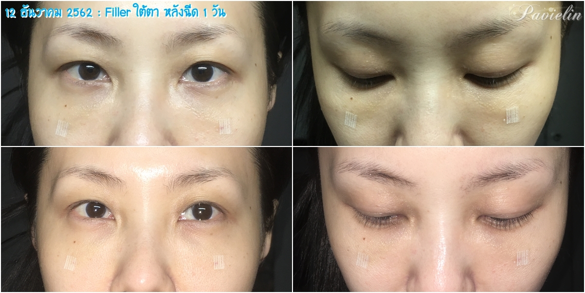 under,eye,filler,procedure,,merz,Before,After,͹,ѧ,ҵѴ,,ѧ״,ѧ״,մ,,Review,ʺó,մ,㵵,մ,,ش,¡,, Filler,,Fareeda Clinic,⺷͡,Ŵ,Ŵ,,ѭ,ͧ֡,, Ѻغ,Ѻͺ,¡Ѻ,,ҧ,س,Ǫҭ,,ҡѷ,Ҥ,,֡,,  ѭ,,Ե,˹,,˹,,غ,֡,,Ᾱ,Ҵ,Ҥ, ا,մѹ,,Belotero,Lidocaine,Soft,ͧͧ,1 ml,Ѻմ, ͹,繡͹,µ,ͧ,Ҫ,Ҫ,ͧ,,,,¤, ѧմ,,,,ѹ,º,,,բ,ͧ֡,մ, Fareeda,Թԡ,,,˹ҧ,Ἱ,Ѿ, Դ,Դ,,ŤԹ,ͧ,,ͤ,, Ң,Ҥù,آԷ13,ҢҺꡫ,Ҵ,,,ش, ʹ,Ҥ,, ҡ,ͧ,