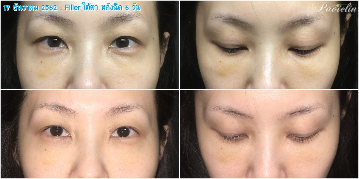 under,eye,filler,procedure,,merz,Before,After,͹,ѧ,ҵѴ,,ѧ״,ѧ״,մ,,Review,ʺó,մ,㵵,մ,,ش,¡,, Filler,,Fareeda Clinic,⺷͡,Ŵ,Ŵ,,ѭ,ͧ֡,, Ѻغ,Ѻͺ,¡Ѻ,,ҧ,س,Ǫҭ,,ҡѷ,Ҥ,,֡,,  ѭ,,Ե,˹,,˹,,غ,֡,,Ᾱ,Ҵ,Ҥ, ا,մѹ,,Belotero,Lidocaine,Soft,ͧͧ,1 ml,Ѻմ, ͹,繡͹,µ,ͧ,Ҫ,Ҫ,ͧ,,,,¤, ѧմ,,,,ѹ,º,,,բ,ͧ֡,մ, Fareeda,Թԡ,,,˹ҧ,Ἱ,Ѿ, Դ,Դ,,ŤԹ,ͧ,,ͤ,, Ң,Ҥù,آԷ13,ҢҺꡫ,Ҵ,,,ش, ʹ,Ҥ,, ҡ,ͧ,