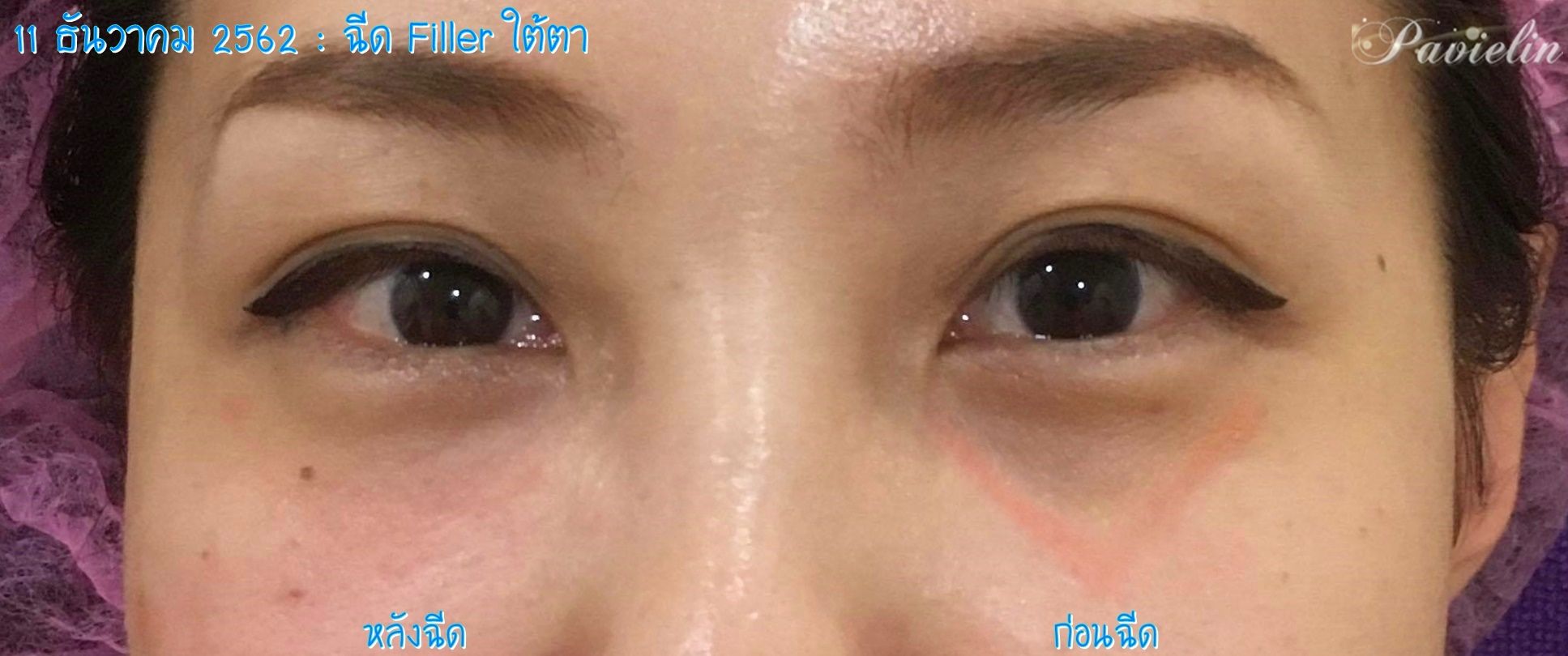under,eye,filler,procedure,ฟิลเลอร์ใต้ตา,merz,Before,After,ก่อน,หลัง,ผ่าตัด,เลาะ,พังผืด,ผังผืด,ฉีดสลาย,รีวิว,Review,ประสบการณ์,ฉีดฟิลเลอร์,ใตต้า,ฟารีดา,ดีไหม,เคสหลุด,ศัลยกรรม,ไม่เจ็บ, Filler,หมอเนย,Fareeda Clinic,โบท็อกซ์,ลดกราม,ลดริ้วรอย,ฟิลเลอร์,แก้ปัญหา,ร่องแก้มลึก,หมอยิ้ม, ขมับยุบ,ขมับตอบ,ยกขมับ,เติม,คาง,คุณหมอ,เชี่ยวชาญ,ยาแท้,จากบริษัทยา,ราคา,ย่อมเยาว์,ปรึกษา,หมอ, ปัญหา,ความงาม,พริตตี้,เหนือแก้ม,แก้มส้ม,หน้าแก่,ใต้ตา,ยุบ,ลึก,ตาโหล่,แพนด้า,ใต้ตาดำ,ใต้ตาคล้ำ, ถุงใต้ตา,ฉีดไขมัน,เนื้อแก้มห้อย,Belotero,Lidocaine,Soft,กล่องสีเหลือง,1 ml,สำหรับฉีดใต้ตา, เนื้อนุ่ม,ไม่เป็นก้อน,สลายตัวหมด,ไม่กอง,แปะยาชา,ทายาชา,ของแท้,แผล,รอยเข็ม,ใต้ตาโบ๋,รอยคล้ำใต้ตา, หลังฉีด,บวม,แก้มบุ๋ม,สวย,กี่วัน,หายบวม,ระยะยาว,สลาย,ดีขึ้น,ร่องแก้มลึก,ฉีดเพิ่ม, Fareeda,คลินิก,มี,อยู่,ที่ไหนบ้าง,แผนที่,เบอร์โทรศัพท์, เปิด,ปิด,เวลา,วอลค์อิน,จอง,คิวเต็ม,รอคิว,คนไข้, สาขา,อาคารเทรนดี้,สุขุมวิท13,สาขาบิ๊กซี,ลาดพร้าว,เมเจอร์,ปิ่นเกล้า,หยุด, สนใจ,เช็คราคา,โปรโมชั่น, ฝาก,จองคิว,