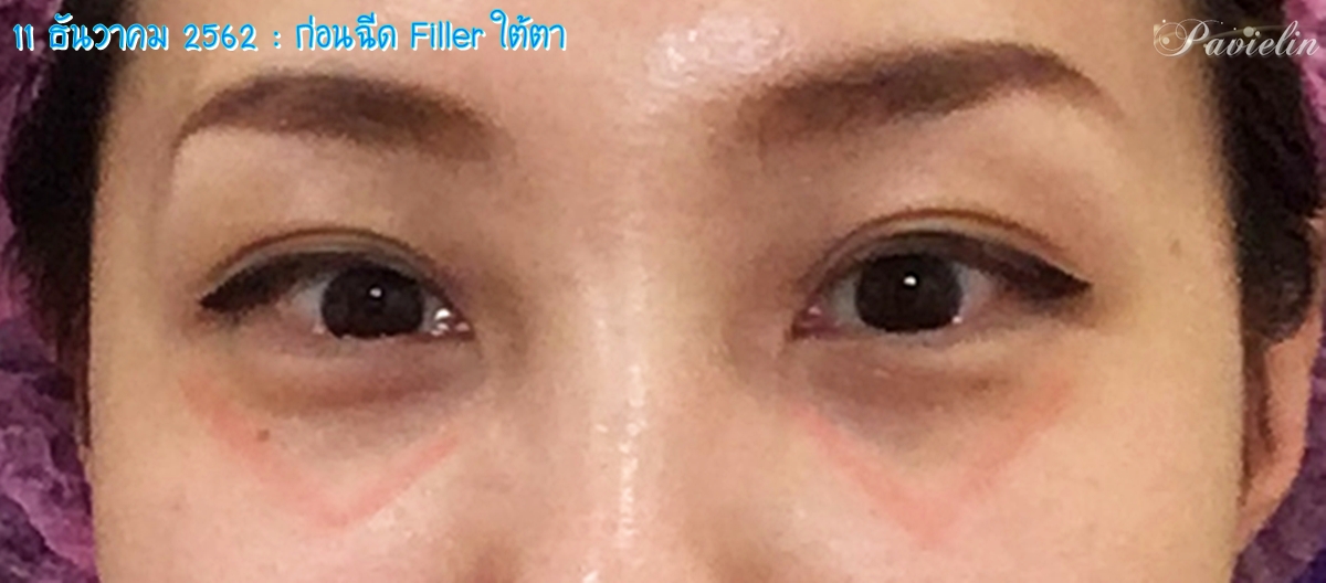 under,eye,filler,procedure,,merz,Before,After,͹,ѧ,ҵѴ,,ѧ״,ѧ״,մ,,Review,ʺó,մ,㵵,մ,,ش,¡,, Filler,,Fareeda Clinic,⺷͡,Ŵ,Ŵ,,ѭ,ͧ֡,, Ѻغ,Ѻͺ,¡Ѻ,,ҧ,س,Ǫҭ,,ҡѷ,Ҥ,,֡,,  ѭ,,Ե,˹,,˹,,غ,֡,,Ᾱ,Ҵ,Ҥ, ا,մѹ,,Belotero,Lidocaine,Soft,ͧͧ,1 ml,Ѻմ, ͹,繡͹,µ,ͧ,Ҫ,Ҫ,ͧ,,,,¤, ѧմ,,,,ѹ,º,,,բ,ͧ֡,մ, Fareeda,Թԡ,,,˹ҧ,Ἱ,Ѿ, Դ,Դ,,ŤԹ,ͧ,,ͤ,, Ң,Ҥù,آԷ13,ҢҺꡫ,Ҵ,,,ش, ʹ,Ҥ,, ҡ,ͧ,