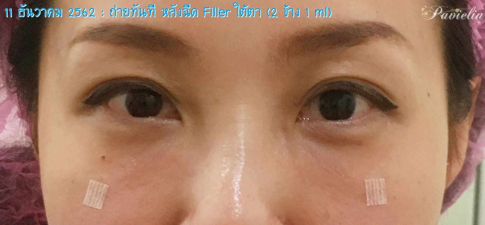 under,eye,filler,procedure,,merz,Before,After,͹,ѧ,ҵѴ,,ѧ״,ѧ״,մ,,Review,ʺó,մ,㵵,մ,,ش,¡,, Filler,,Fareeda Clinic,⺷͡,Ŵ,Ŵ,,ѭ,ͧ֡,, Ѻغ,Ѻͺ,¡Ѻ,,ҧ,س,Ǫҭ,,ҡѷ,Ҥ,,֡,,  ѭ,,Ե,˹,,˹,,غ,֡,,Ᾱ,Ҵ,Ҥ, ا,մѹ,,Belotero,Lidocaine,Soft,ͧͧ,1 ml,Ѻմ, ͹,繡͹,µ,ͧ,Ҫ,Ҫ,ͧ,,,,¤, ѧմ,,,,ѹ,º,,,բ,ͧ֡,մ, Fareeda,Թԡ,,,˹ҧ,Ἱ,Ѿ, Դ,Դ,,ŤԹ,ͧ,,ͤ,, Ң,Ҥù,آԷ13,ҢҺꡫ,Ҵ,,,ش, ʹ,Ҥ,, ҡ,ͧ,