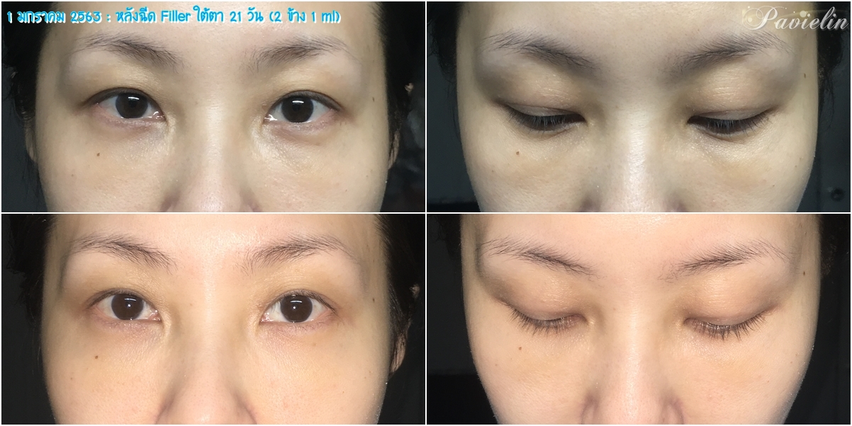 under,eye,filler,procedure,,merz,Before,After,͹,ѧ,ҵѴ,,ѧ״,ѧ״,մ,,Review,ʺó,մ,㵵,մ,,ش,¡,, Filler,,Fareeda Clinic,⺷͡,Ŵ,Ŵ,,ѭ,ͧ֡,, Ѻغ,Ѻͺ,¡Ѻ,,ҧ,س,Ǫҭ,,ҡѷ,Ҥ,,֡,,  ѭ,,Ե,˹,,˹,,غ,֡,,Ᾱ,Ҵ,Ҥ, ا,մѹ,,Belotero,Lidocaine,Soft,ͧͧ,1 ml,Ѻմ, ͹,繡͹,µ,ͧ,Ҫ,Ҫ,ͧ,,,,¤, ѧմ,,,,ѹ,º,,,բ,ͧ֡,մ, Fareeda,Թԡ,,,˹ҧ,Ἱ,Ѿ, Դ,Դ,,ŤԹ,ͧ,,ͤ,, Ң,Ҥù,آԷ13,ҢҺꡫ,Ҵ,,,ش, ʹ,Ҥ,, ҡ,ͧ,