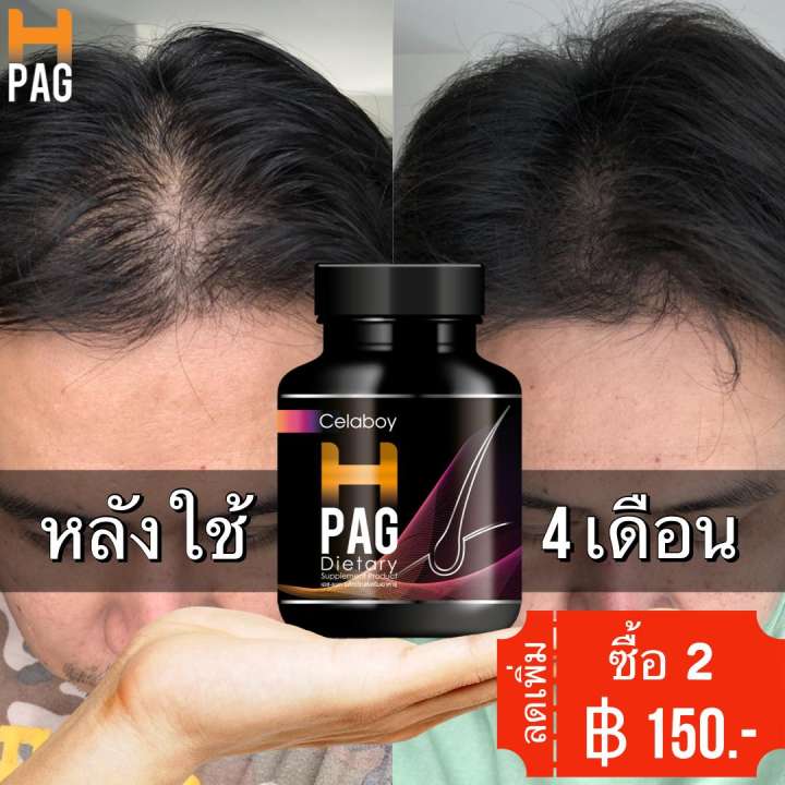 H-PAG (อาหารเสริม) ยาปลูกผม ปลูกผม อาหารเสริมเส้นผม หยุดผมร่วง (30 แคปซูล)