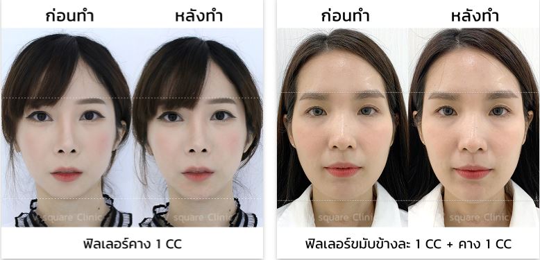 รีวิวฟิลเลอร์คาง 1CC