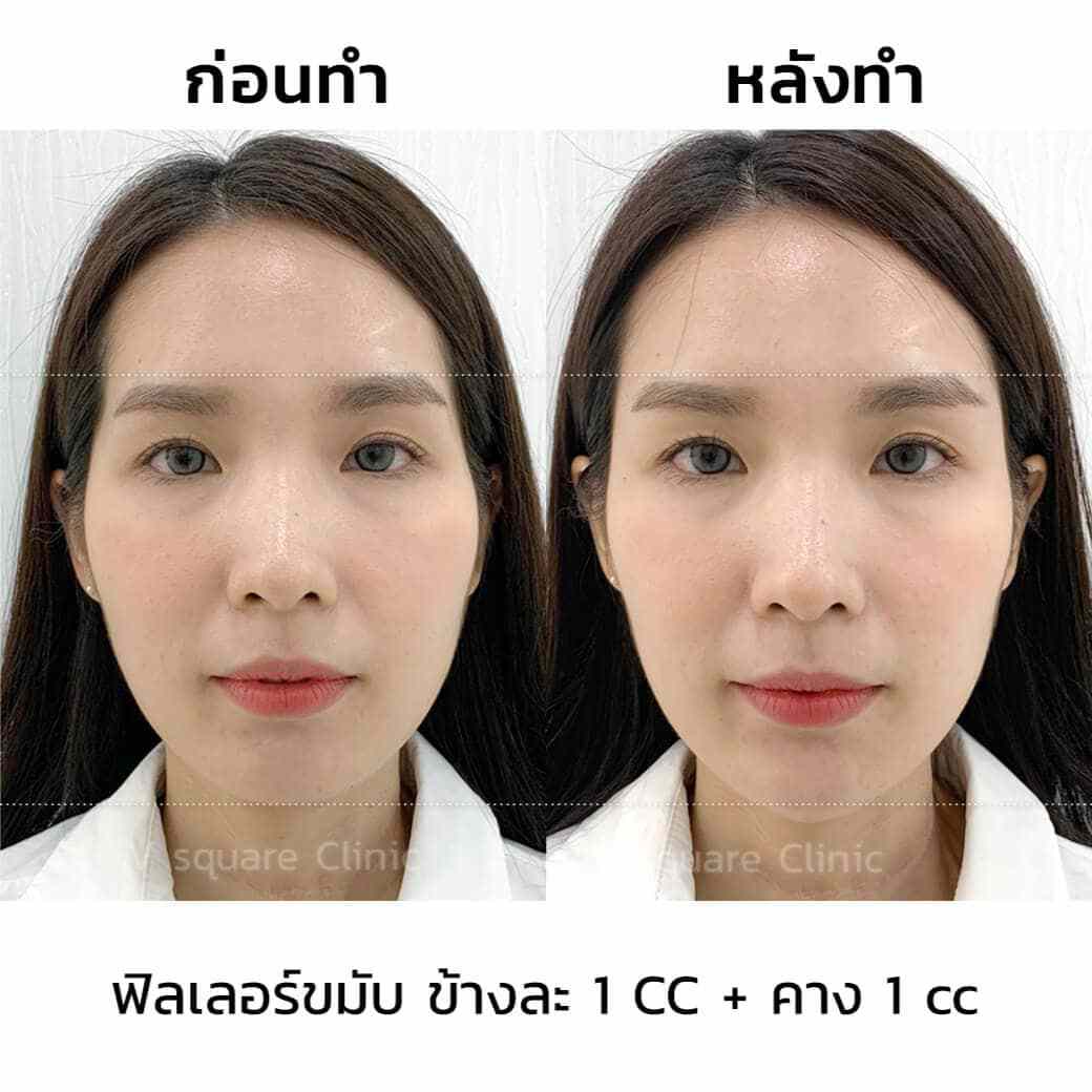 รีวิวฟิลเลอร์คาง 1CC เปรียบเทียบก่อน-หลังทำ