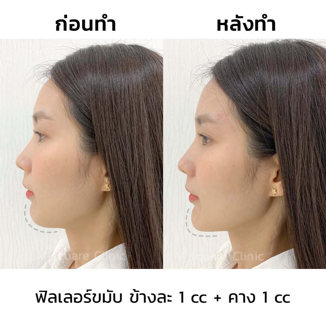 ฟิลเลอร์คาง รีวิว 1CC