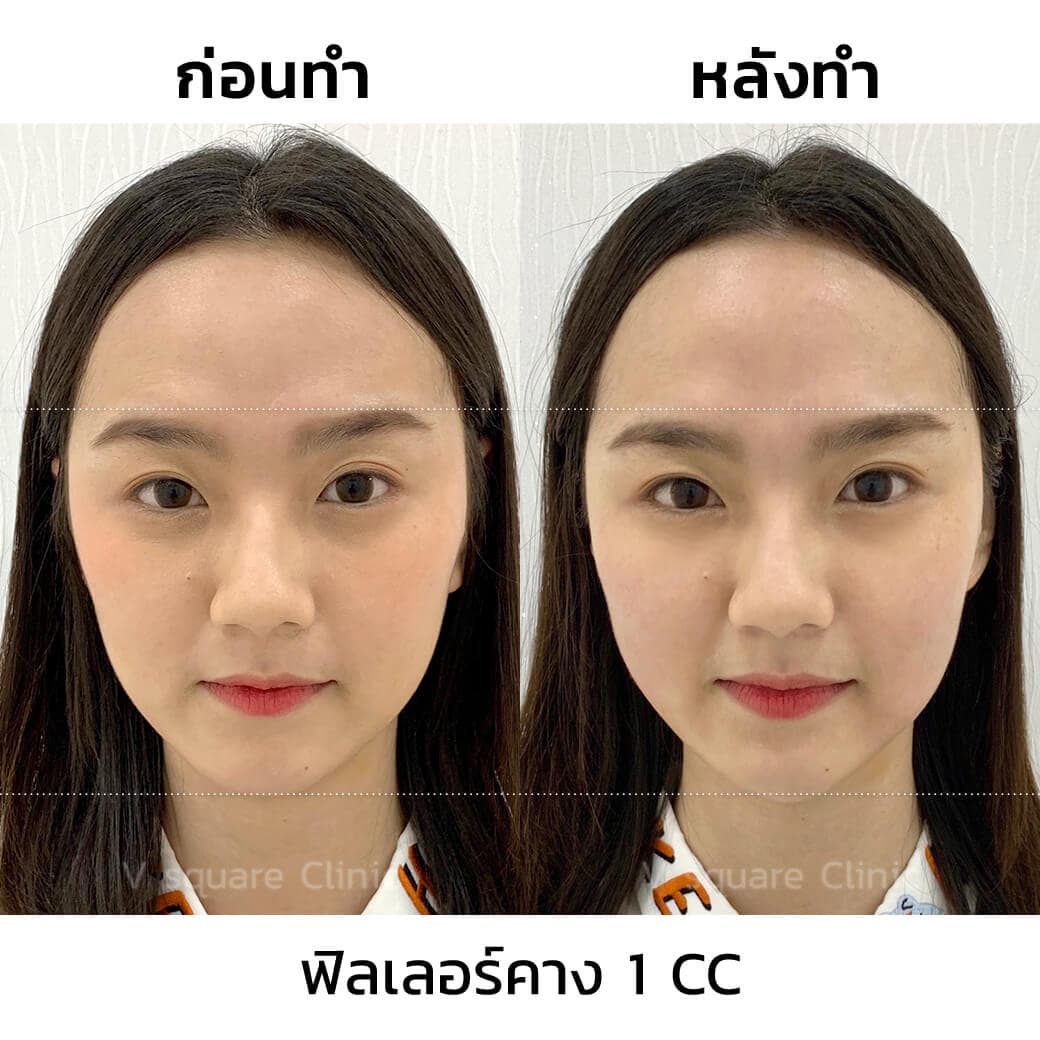 รีวิวฟิลเลอร์คาง 1CC ราคา